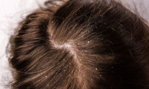 सर्दियों में किस तरह पाए Dandruff से निजात, जाने उपाय