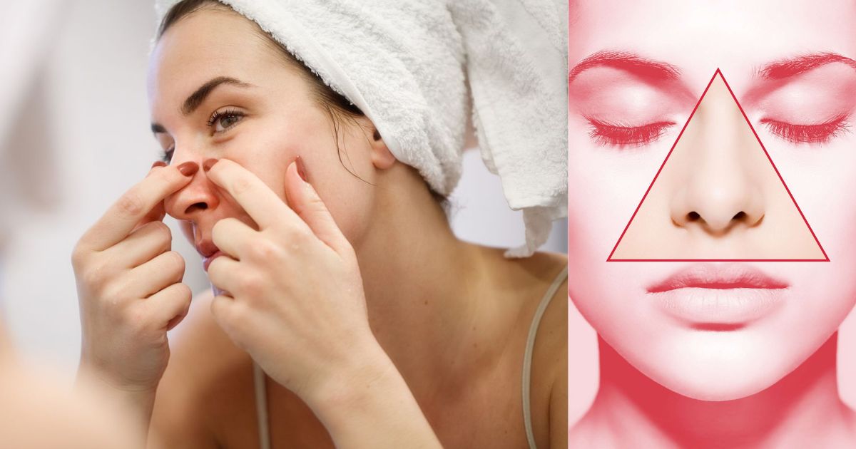 Popping pimples near the nose and lips can be dangerous