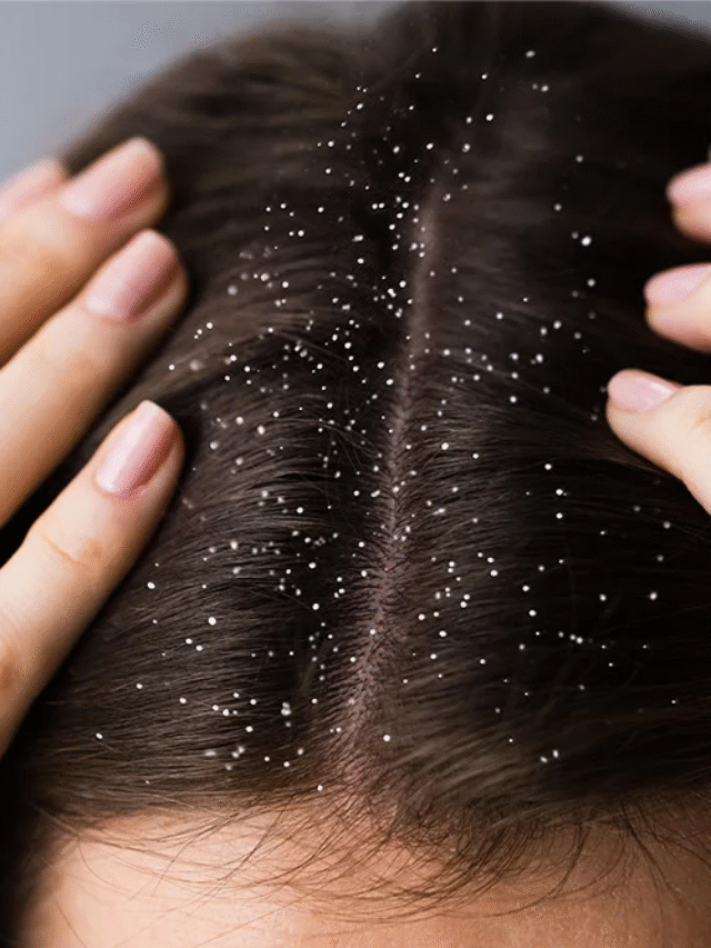 सर्दियों में डैंड्रफ भागने का सबसे आसान तरीका