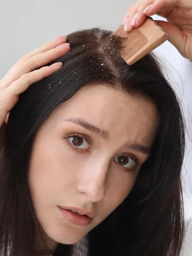 dandruff_bbc6035132293939b3f124720dcf9614_fb974f87-e08b-4a25-81e3-1a3e64780926