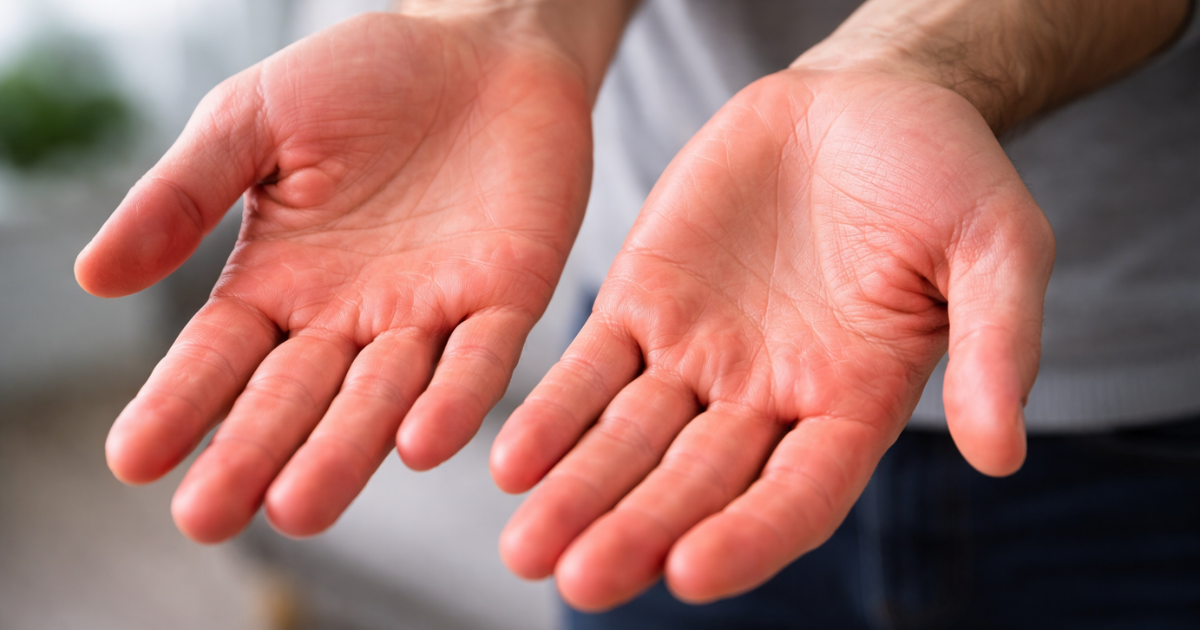 Red Palms Warning: क्या आपकी हथेलियां रहती हैं लाल? जानिए किस गंभीर बीमारी का संकेत हो सकता है