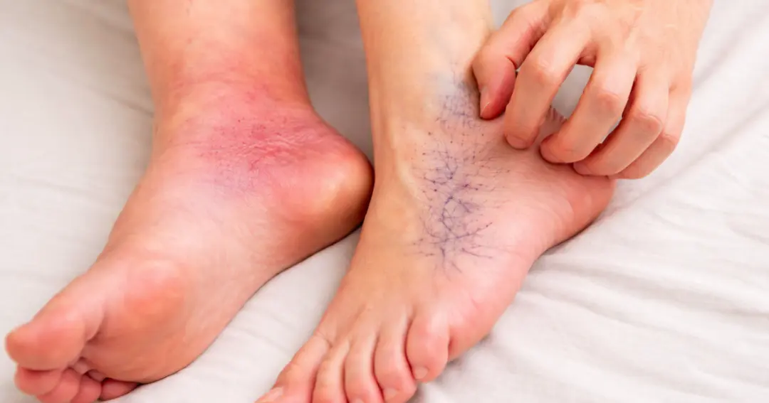 पैरों में दिखने वाले ये 7 संकेत हो सकते हैं लिवर डैमेज के लक्षण, समय रहते पहचानना है जरूरी