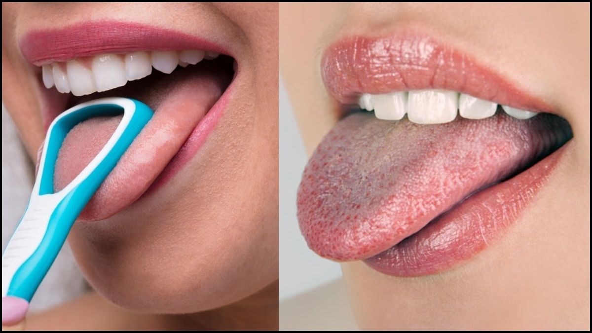 Color and texture of the tongue