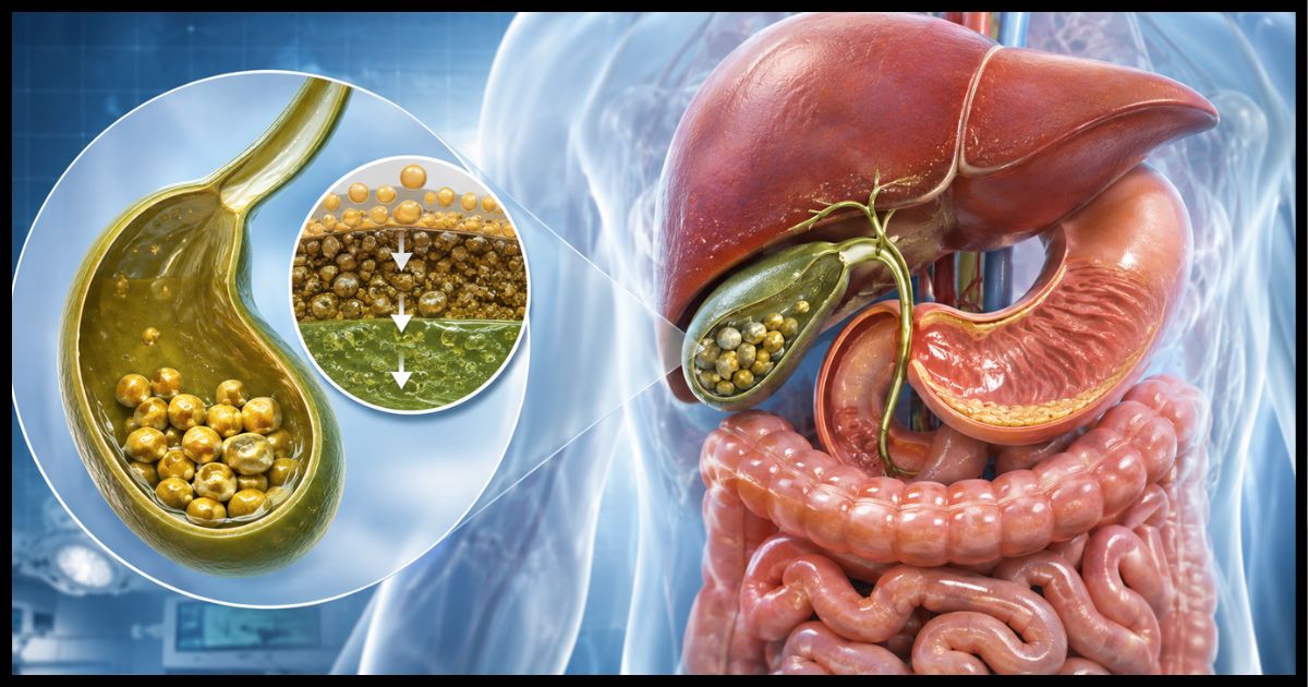 Gallbladder Stones: पित्त की थैली में कैसे बनती है पथरी? जानें कारण, लक्षण और इलाज