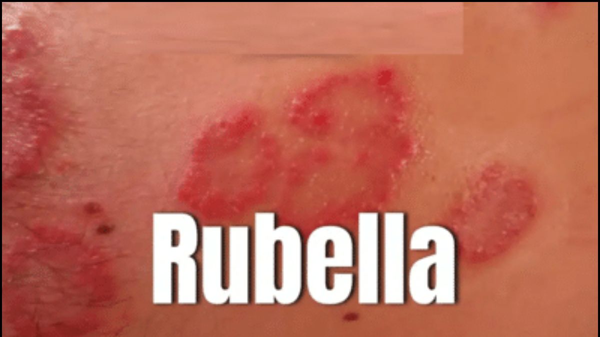 Jharkhand Rubella Virus