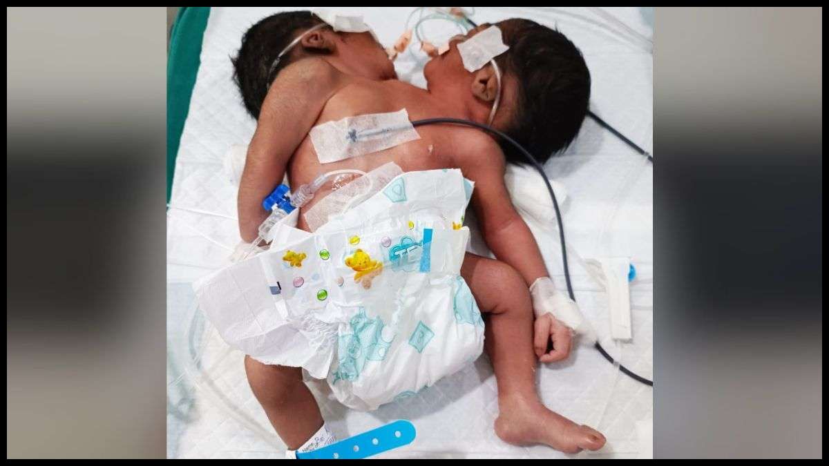 Odisha: दो सिर और एक शरीर वाले दुर्लभ जुड़वां बच्चों का जन्म, हालत गंभीर; डॉक्टरों की विशेष टीम कर रही इलाज